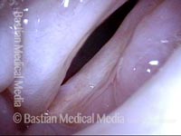 pikkelyes papilloma uvula patológia körvonalai