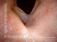 pikkelyes papilloma uvula patológia körvonalai)