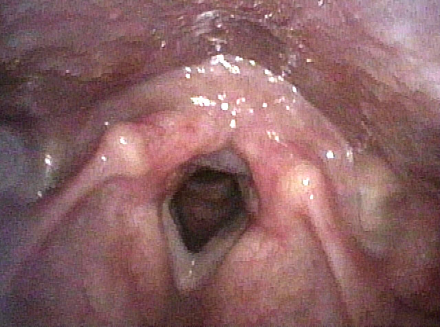 Post-swallow hypopharyngeal image