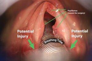 breathing tube potential injury for treatment of RRP