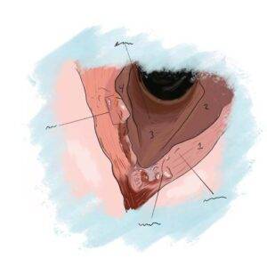 Illustration of vocal cord cancer in the larynx