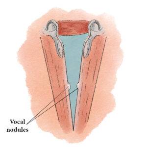 Vocal Nodules Illustration