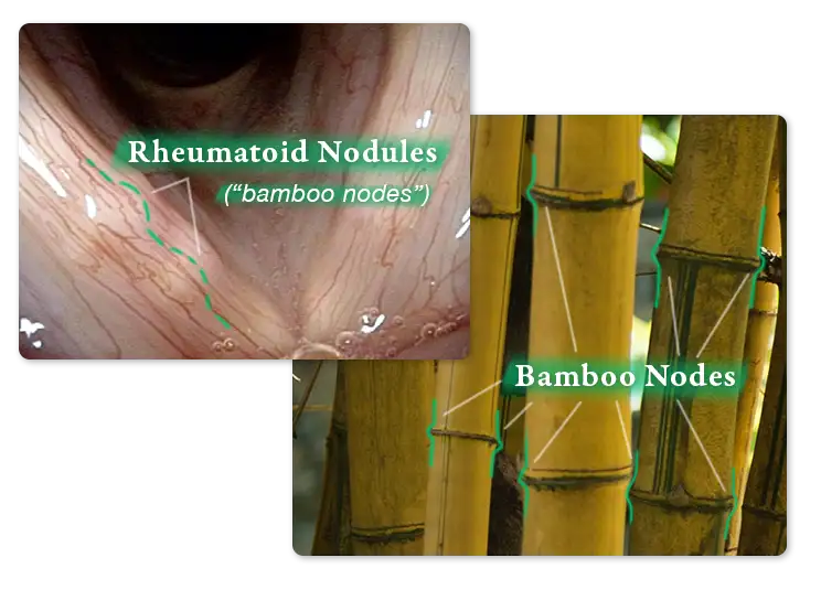Bamboo nodes on trees compared to vocal cord nodules