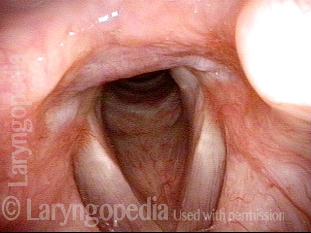 corrected vocal cords