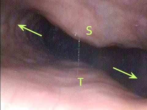 Dramatic lateral dilation of the upper esophagus is a symptom of R-CPD