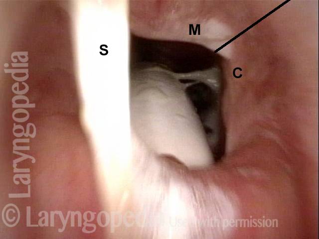 junction between membranous and cartilaginous trachea.
