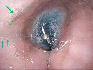 Liquid in the lower esophagus