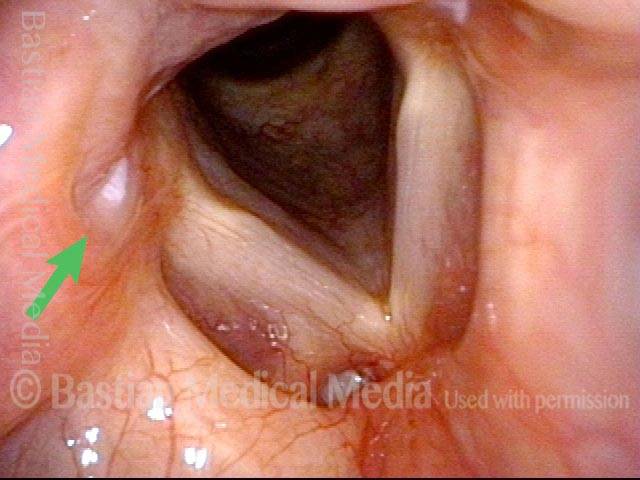 Small ulcer with surrounding erythema