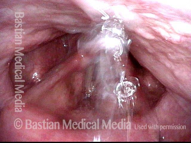 water in the larynx