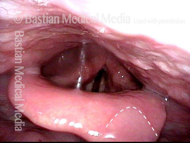 water on the epiglottis