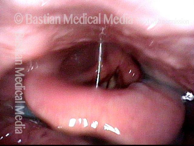 water causes coughing in the laryngeal vestibule
