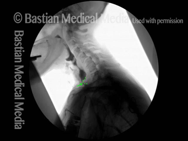 VFSS of the neck while swallowing barium