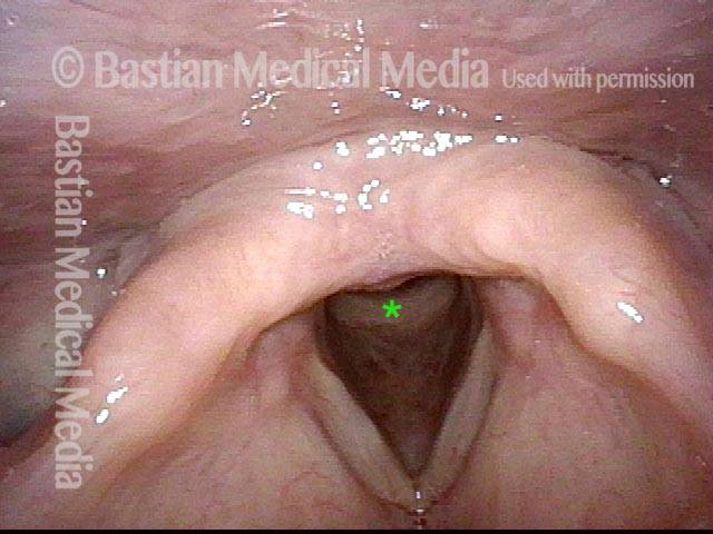 entrance to her larynx