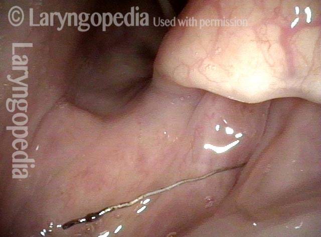 bristle stuck in the esophagus