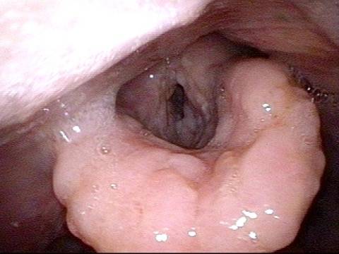 recrudescence of the infection with granularity throughout the laryngeal vestibule