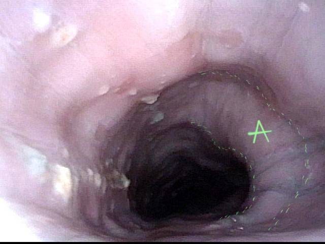 A view of the mid-esophagus