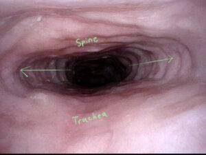 dilation of the upper esophagus