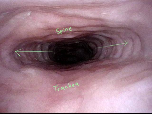 dilation of the upper esophagus