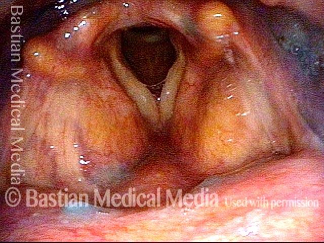 Blue applesauce on the laryngeal surface of the epiglottis