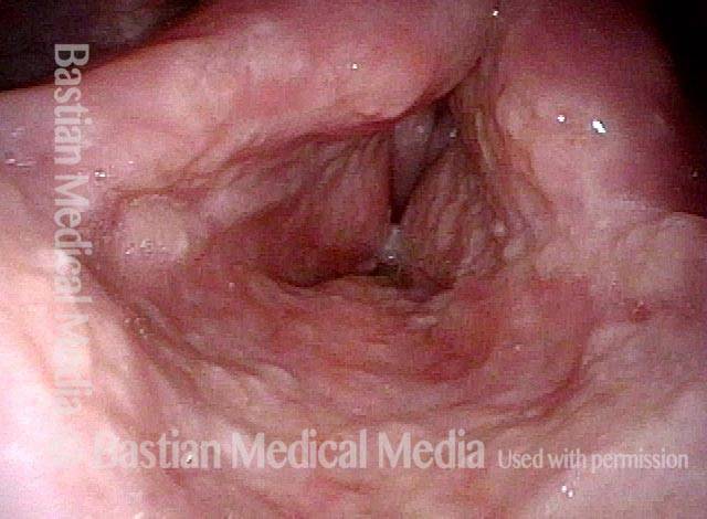 laryngeal vestibule