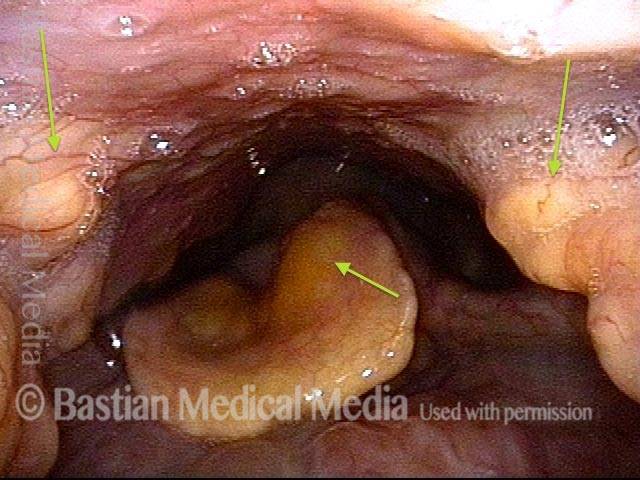 ubmucosal amyloid deposits in pharyngeal walls and epiglottis