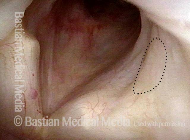 otted lines indicate where the ulcer would be if still present