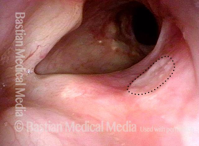 flat ulcer with surrounding redness