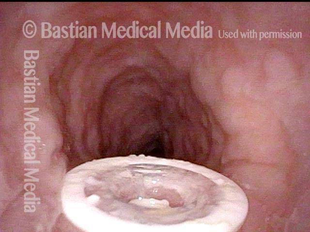 flange of the tracheoesophageal prosthesis