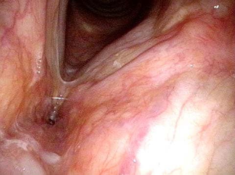 Larynx Lipoma