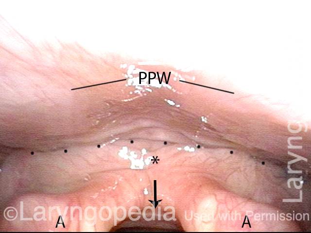 between posterior pharyngeal wall and arytenoid eminences