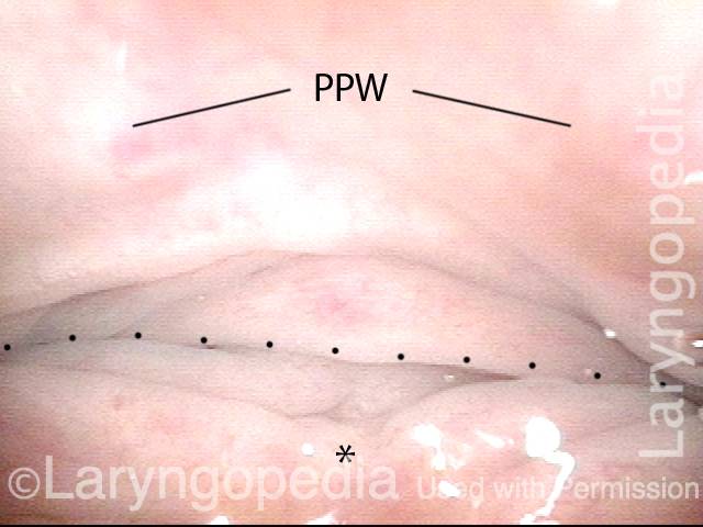 entrance to the esophagus
