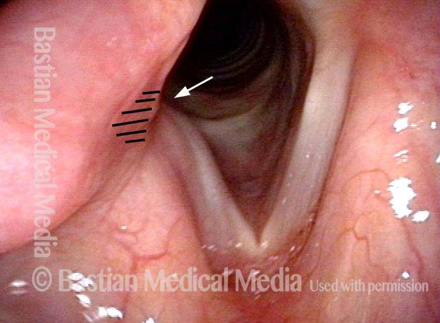vocal cord ankylosis