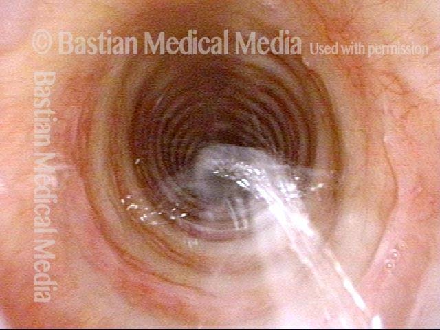 Water in trachea