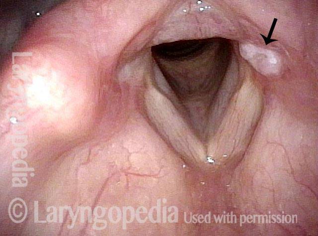 lesion on the left vocal cord
