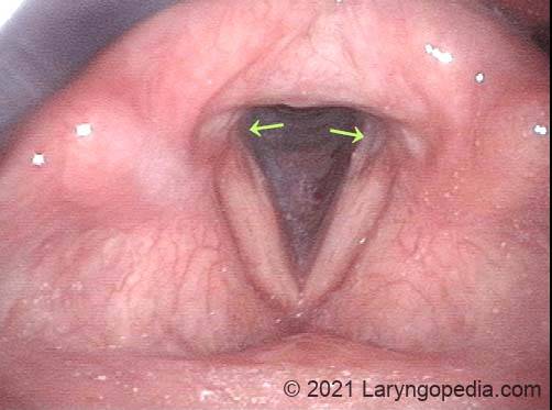 Erosions in the vocal cords