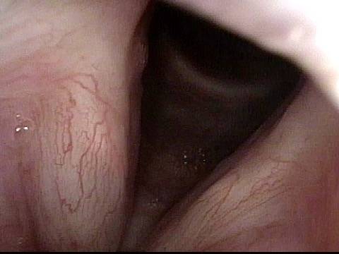 Vocal Cords