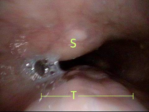 air from below further dilates the upper esophagus