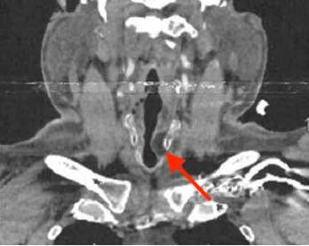 coronal CT image