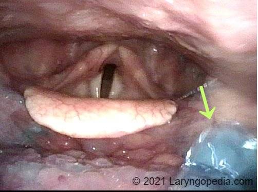 blue water flowing into laryngeal vestibule