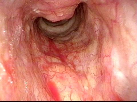 diffuse subglottic infiltration