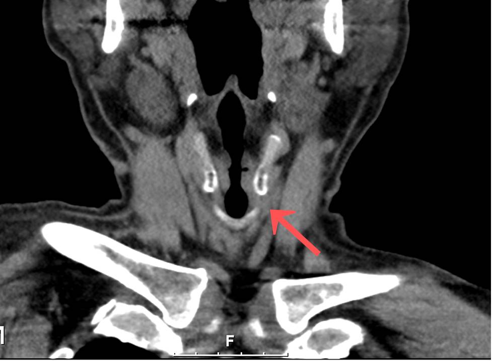 CT image 6 months after surgery