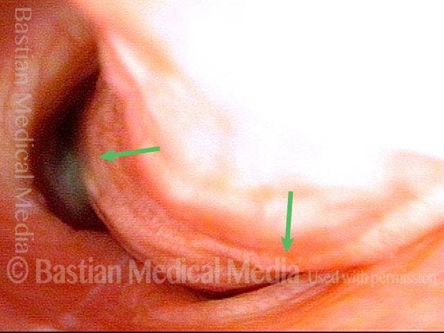 anterior bulging of the tracheoesophageal party wall