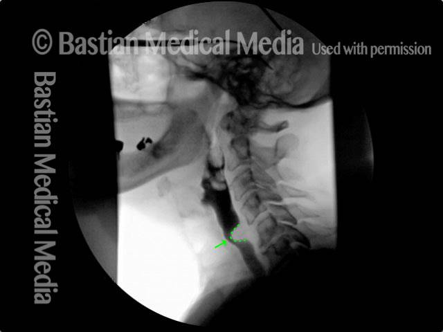 Lateral x-ray of the neck while swallowing barium