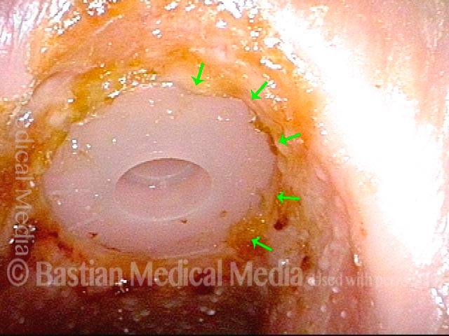 Tracheal flange beginning to embed