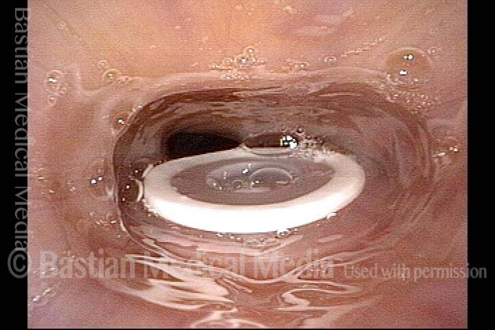 Tracheoesophageal voice prosthesis, corrected fitting