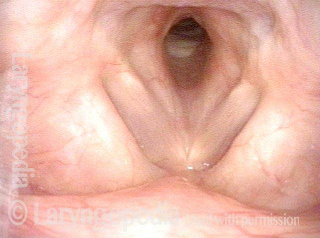 dilation of idiopathic subglottic stenosis