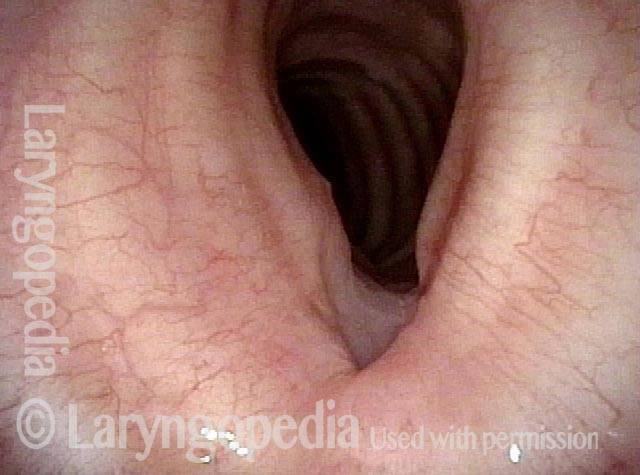 Closer view of trachea