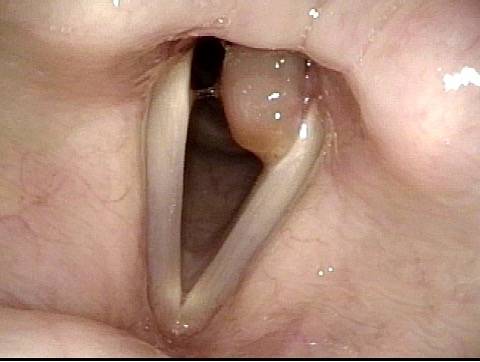 intubation granuloma on vocal cords