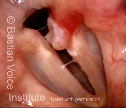 right fold fitting into the groove between the two lobes of the contact granuloma