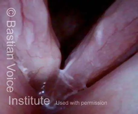Right epidermoid cyst during breathing